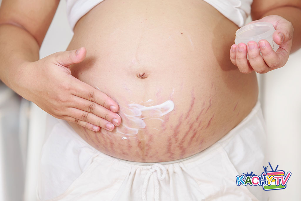 Pregnancy Stretch Marks? Causes, prevention and treatment
